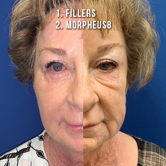 Non-Surgical